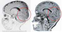 Tiny variation in 1 gene may have led to crucial changes in human brain