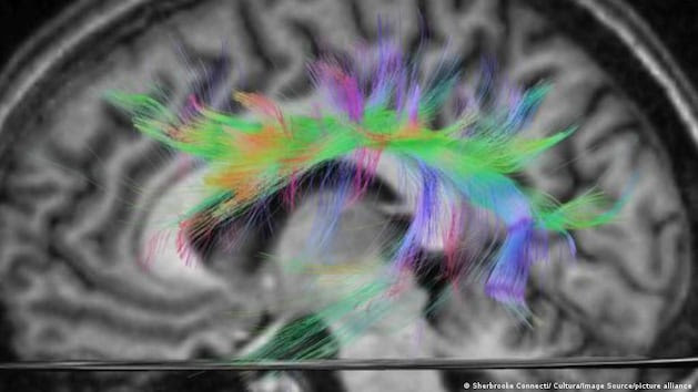 Araştırmacılar kekemeliğin kökenini beyinde buluyor