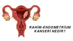 Almanya'da her yıl yaklaşık 7.300 kadında yumurtalık kanseri gelişiyor.Yumurtalık kanserinin en büyük tehlikesi genellikle çok geç fark edilmesi ve uzun süre semptom görülmemesidir. - yumurtalik rahim kanseri nedir